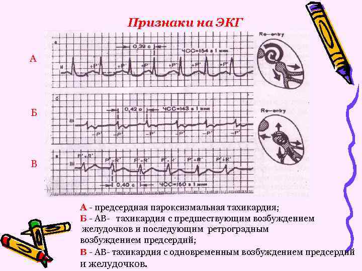 Пароксизмальная тахикардия на экг. Предсердная тахикардия на ЭКГ признаки. Предсердная пароксизмальная тахикардия на ЭКГ признаки. Возбуждение желудочков на ЭКГ. Предсердная АВ пароксизмальная тахикардия.