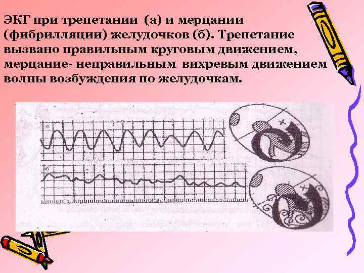 Как выглядит фибрилляция желудочков на мониторе