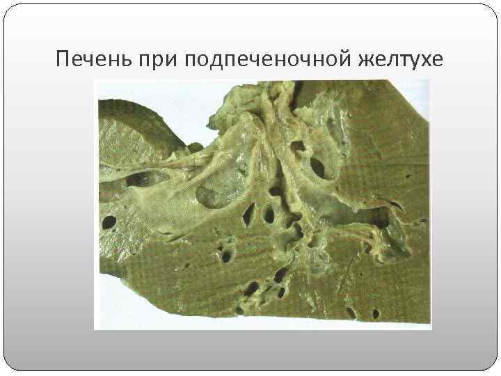 Зеленая печень. Механическая желтуха печени макропрепарат. Макропрепарат печень при подпеченочной желтухе. Печень при подпеченочной желтухе. Печень при механической желтухе макропрепарат.