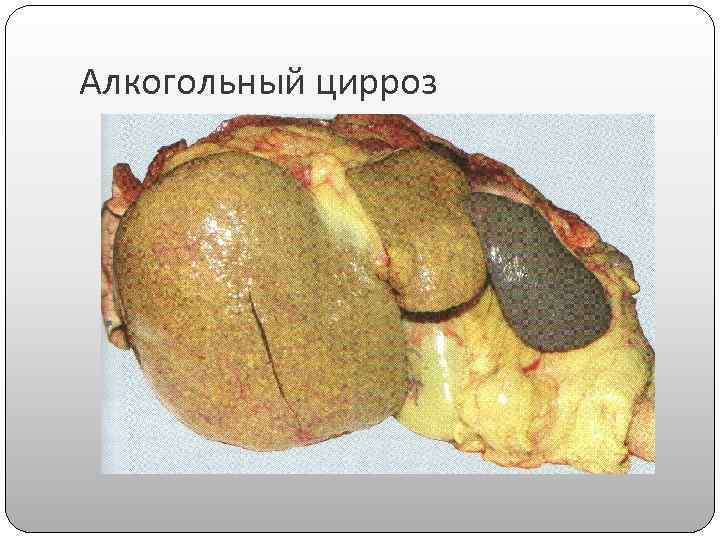 Алкогольный цирроз 