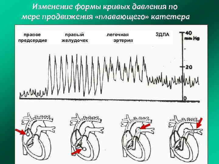 Изменение формы кривых давления по мере продвижения «плавающего» катетера правое предсердие правый желудочек легочная