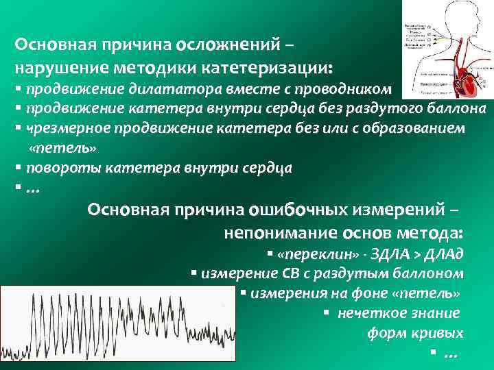 Основная причина осложнений – нарушение методики катетеризации: § продвижение дилататора вместе с проводником §