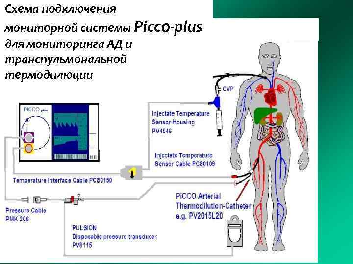 Схема подключения мониторной системы Picco-plus для мониторинга АД и транспульмональной термодилюции 