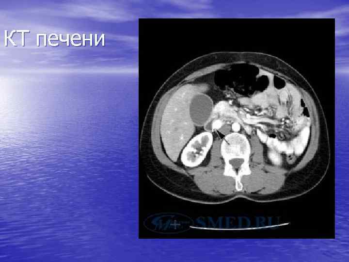 КТ печени 