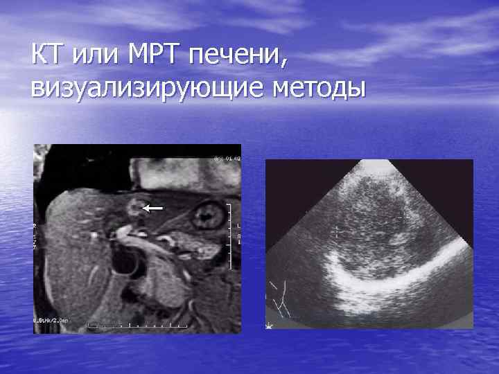 КТ или МРТ печени, визуализирующие методы 
