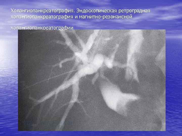 Холангиопанкреатография. Эндоскопическая ретроградная холангиопанкреатография и магнитно-резонансной холангиопанкреатографии 