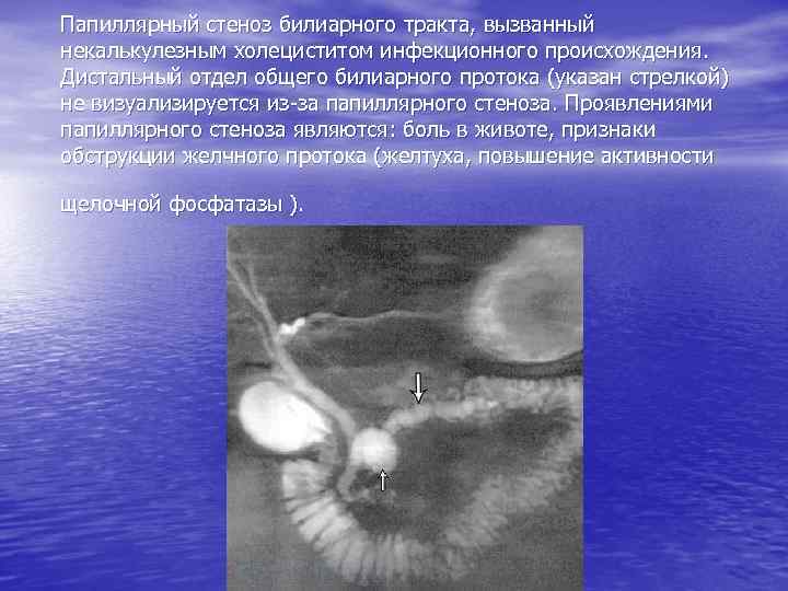 Папиллярный стеноз билиарного тракта, вызванный некалькулезным холециститом инфекционного происхождения. Дистальный отдел общего билиарного протока