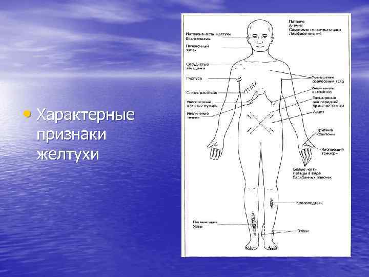  • Характерные признаки желтухи 