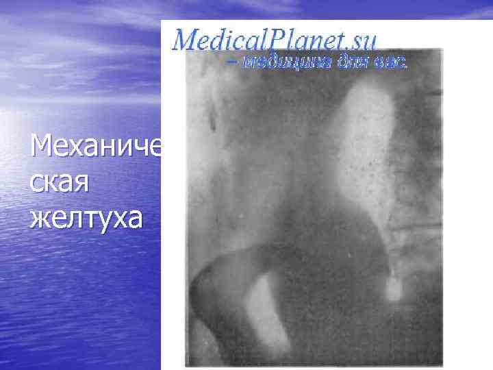Механиче ская желтуха 