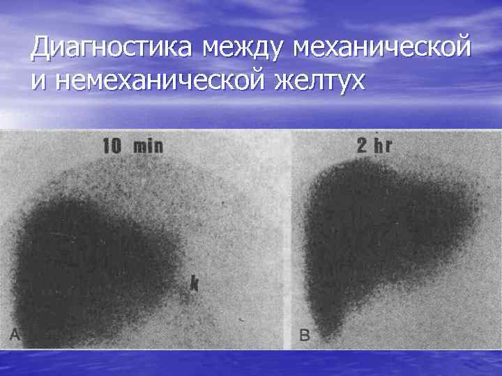 Диагностика между механической и немеханической желтух 