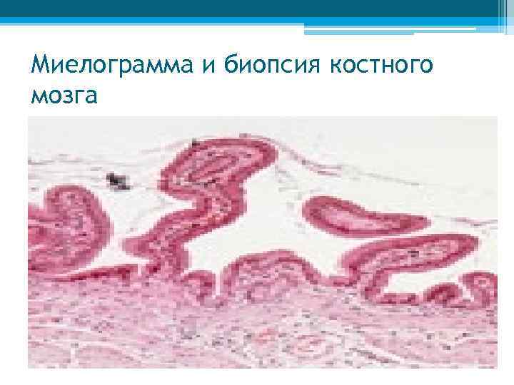 Миелограмма и биопсия костного мозга 