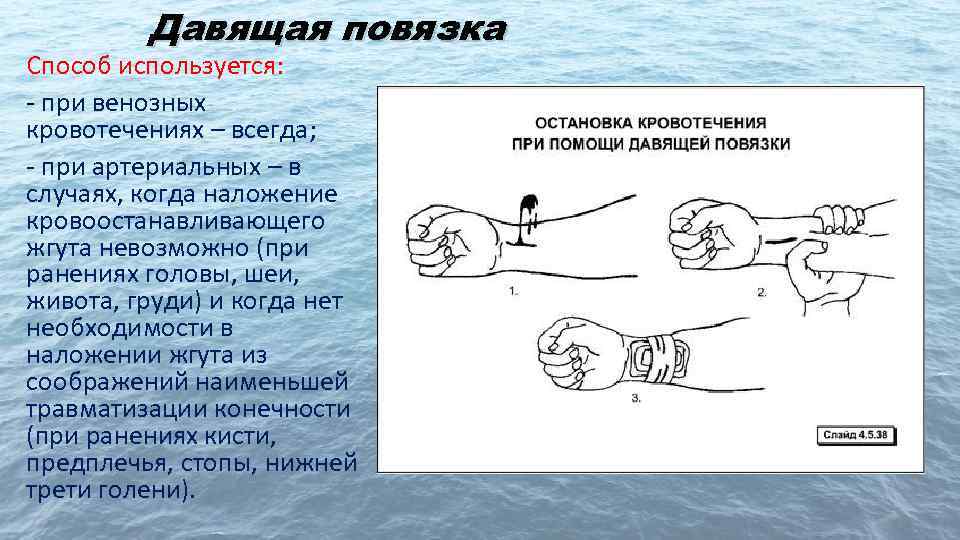 Давящая повязка Способ используется: - при венозных кровотечениях – всегда; - при артериальных –