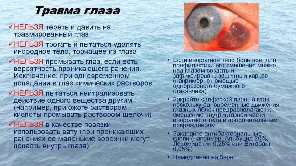 Травма глаза üНЕЛЬЗЯ тереть и давить на травмированный глаз üНЕЛЬЗЯ трогать и пытаться удалять