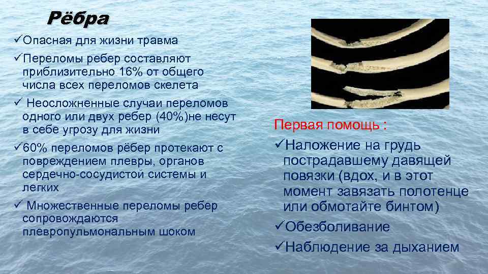 Рёбра üОпасная для жизни травма üПереломы ребер составляют приблизительно 16% от общего числа всех