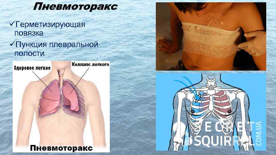 Пневмоторакс üГерметизирующая повязка üПункция плевральной полости 