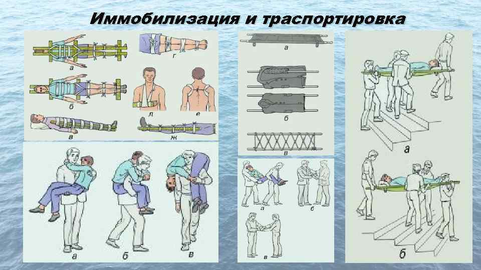 Иммобилизация и траспортировка 