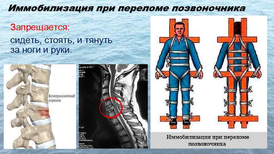 Иммобилизация при переломе позвоночника Запрещается: сидеть, стоять, и тянуть за ноги и руки. 