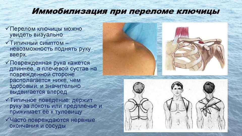 Иммобилизация при переломе ключицы üПерелом ключицы можно увидеть визуально üТипичный симптом – невозможность поднять