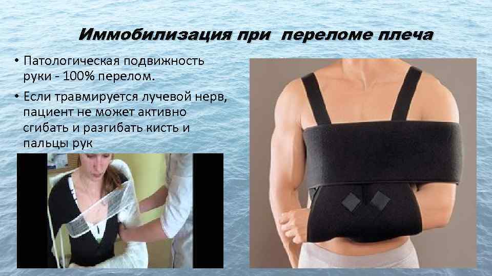 Иммобилизация при переломе плеча • Патологическая подвижность руки - 100% перелом. • Если травмируется