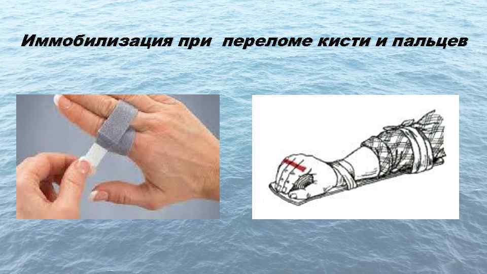 Иммобилизация при переломе кисти и пальцев 