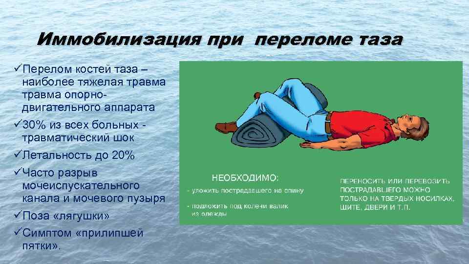 Иммобилизация при переломе таза üПерелом костей таза – наиболее тяжелая травма опорнодвигательного аппарата ü