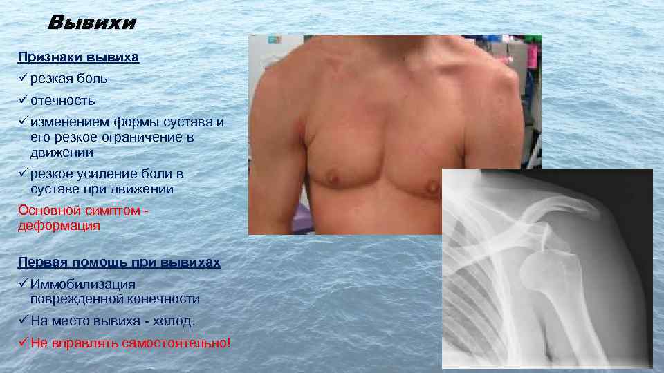Вывих плечевого сустава симптомы у взрослых фото