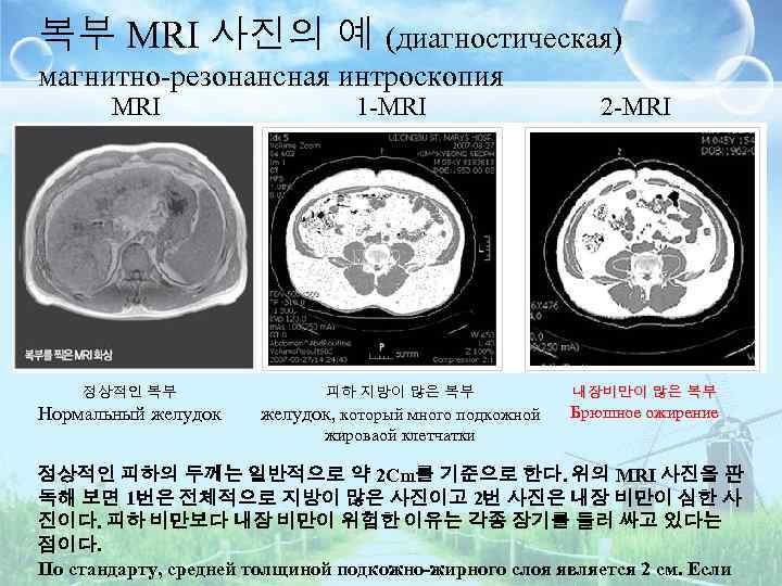 복부 MRI 사진의 예 (диагностическая) магнитно-резонансная интроскопия MRI 1 -MRI 2 -MRI 정상적인 복부