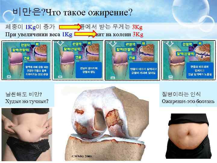 비만은? Что такое ожирение? 체중이 1 Kg이 증가 무릎에서 받는 무게는 3 Kg 1