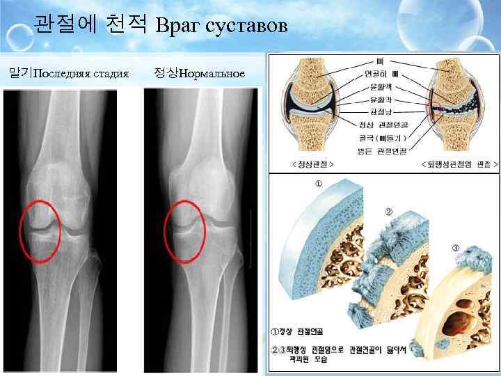 관절에 천적 Враг суставов 말기Последняя стадия 정상Нормальное состояние 