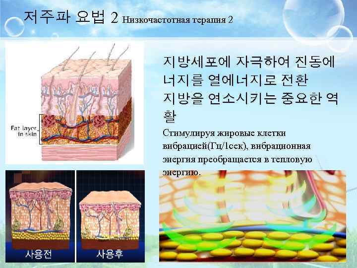 저주파 요법 2 Низкочастотная терапия 2 지방세포에 자극하여 진동에 너지를 열에너지로 전환 지방을 연소시키는