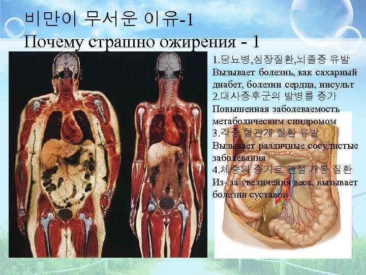 비만이 무서운 이유-1 Почему страшно ожирения - 1 1. 당뇨병, 심장질환, 뇌졸증 유발 Вызывает
