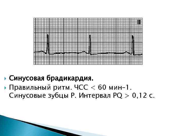  Синусовая брадикардия. Правильный ритм. ЧСС < 60 мин– 1. Синусовые зубцы P. Интервал
