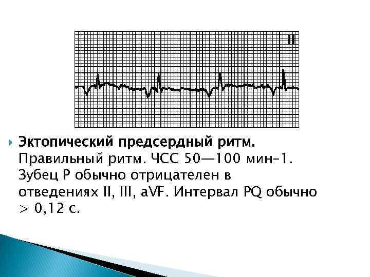  Эктопический предсердный ритм. Правильный ритм. ЧСС 50— 100 мин– 1. Зубец P обычно