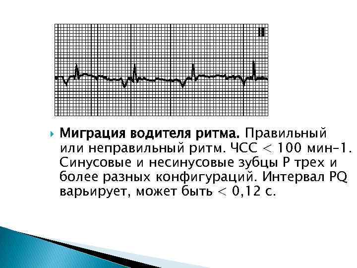  Миграция водителя ритма. Правильный или неправильный ритм. ЧСС < 100 мин– 1. Синусовые