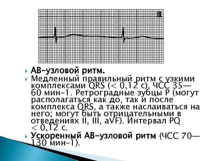  АВ-узловой ритм. Медленный правильный ритм с узкими комплексами QRS (< 0, 12 с).