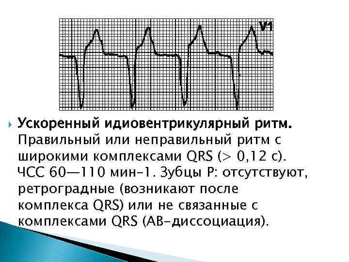  Ускоренный идиовентрикулярный ритм. Правильный или неправильный ритм с широкими комплексами QRS (> 0,