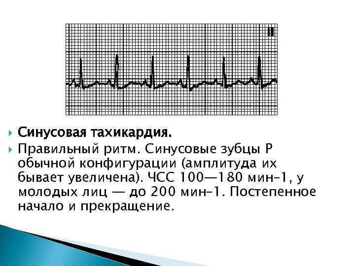  Синусовая тахикардия. Правильный ритм. Синусовые зубцы P обычной конфигурации (амплитуда их бывает увеличена).