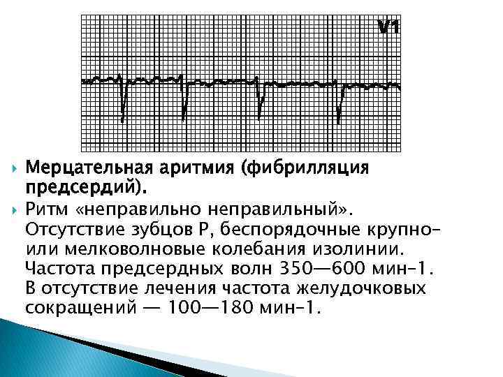  Мерцательная аритмия (фибрилляция предсердий). Ритм «неправильно неправильный» . Отсутствие зубцов P, беспорядочные крупноили