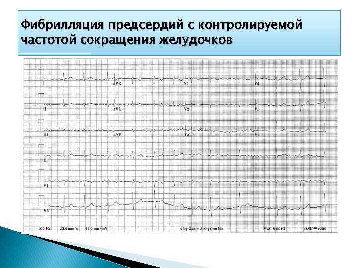 Фибрилляция предсердий с контролируемой частотой сокращения желудочков 