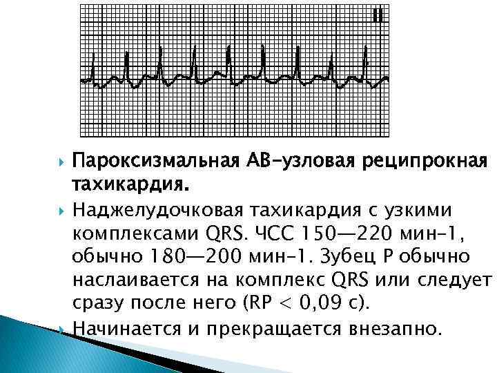  Пароксизмальная АВ-узловая реципрокная тахикардия. Наджелудочковая тахикардия с узкими комплексами QRS. ЧСС 150— 220