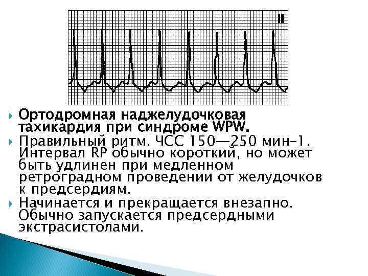  Ортодромная наджелудочковая тахикардия при синдроме WPW. Правильный ритм. ЧСС 150— 250 мин– 1.