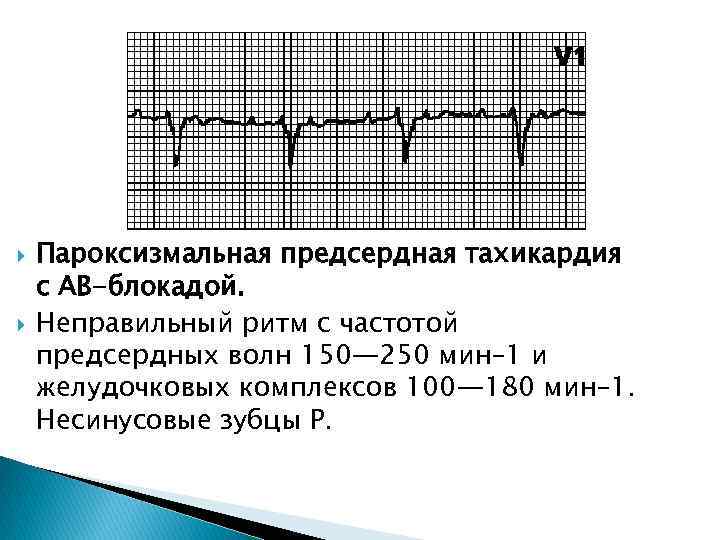  Пароксизмальная предсердная тахикардия с АВ-блокадой. Неправильный ритм с частотой предсердных волн 150— 250