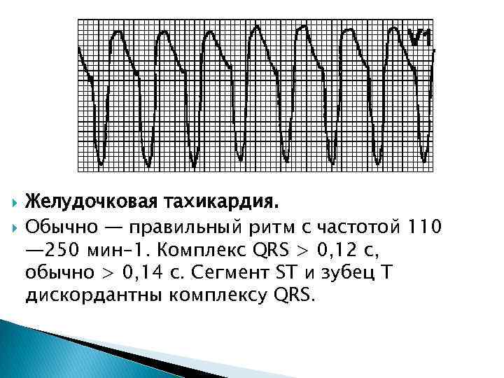  Желудочковая тахикардия. Обычно — правильный ритм с частотой 110 — 250 мин– 1.