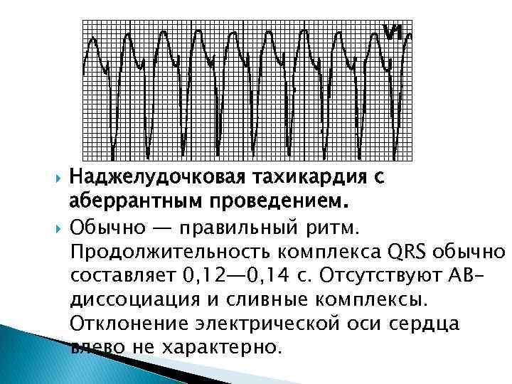  Наджелудочковая тахикардия с аберрантным проведением. Обычно — правильный ритм. Продолжительность комплекса QRS обычно