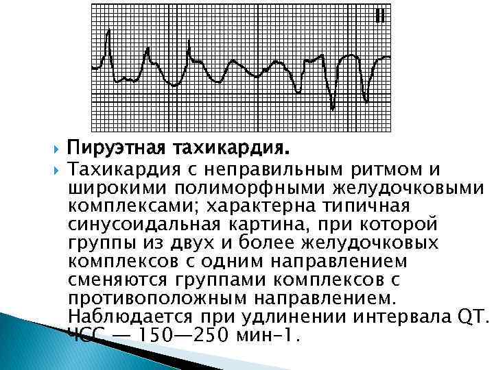 Пируэтная тахикардия. Тахикардия с неправильным ритмом и широкими полиморфными желудочковыми комплексами; характерна типичная