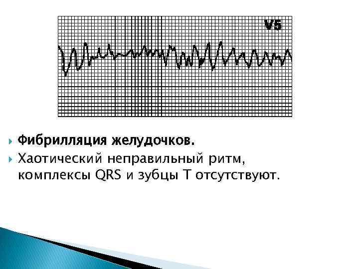  Фибрилляция желудочков. Хаотический неправильный ритм, комплексы QRS и зубцы T отсутствуют. 