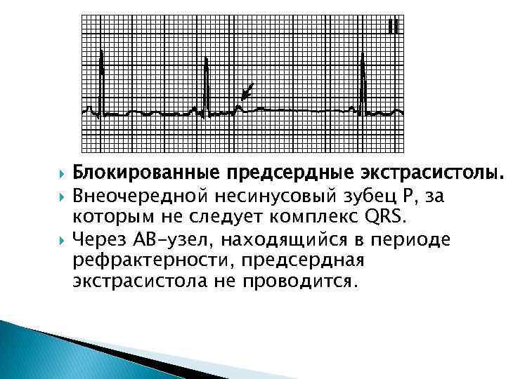 Предсердные экстрасистолы. Блокированная желудочковая экстрасистолия. Блокированная предсердная экстрасистолия на ЭКГ. Блокированная желудочковая экстрасистолия ЭКГ. При блокированных предсердных экстрасистолах комплекс QRS.