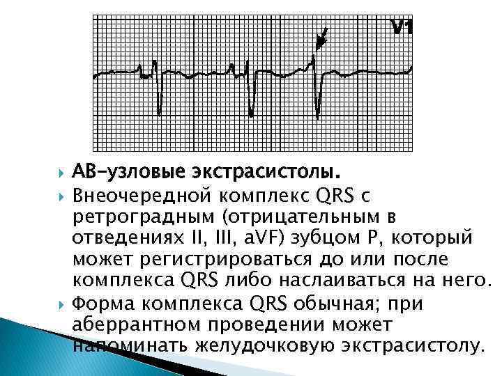  АВ-узловые экстрасистолы. Внеочередной комплекс QRS с ретроградным (отрицательным в отведениях II, III, a.