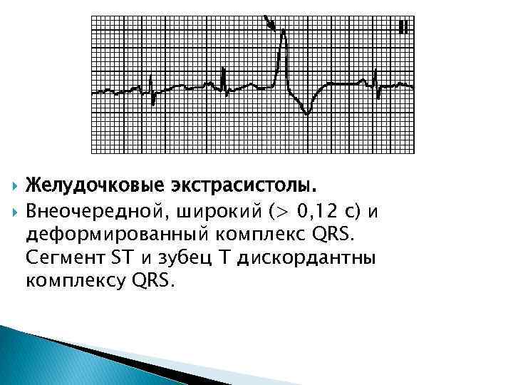  Желудочковые экстрасистолы. Внеочередной, широкий (> 0, 12 с) и деформированный комплекс QRS. Сегмент