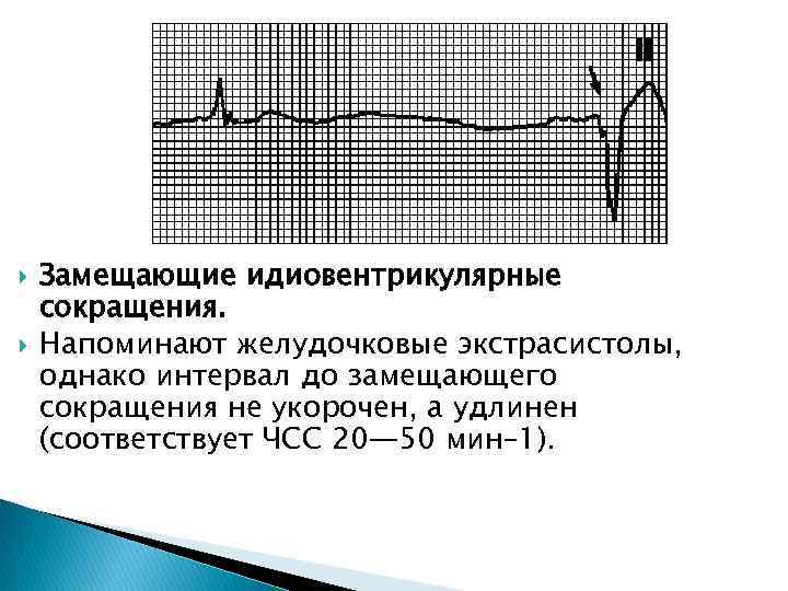  Замещающие идиовентрикулярные сокращения. Напоминают желудочковые экстрасистолы, однако интервал до замещающего сокращения не укорочен,